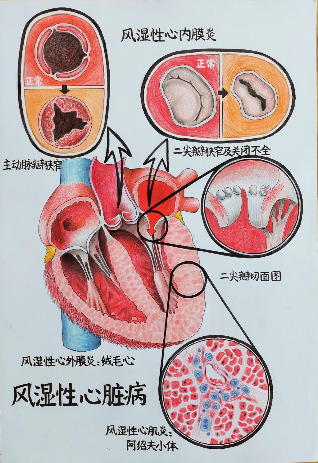 2. 邮寄手绘 作品分类 2 风湿性心脏病 91直播
 张晨彤